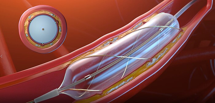 Download image (.jpg) (opens in a new window) Philips Scoring Balloon Catheter RX – AngioSculpt Evo