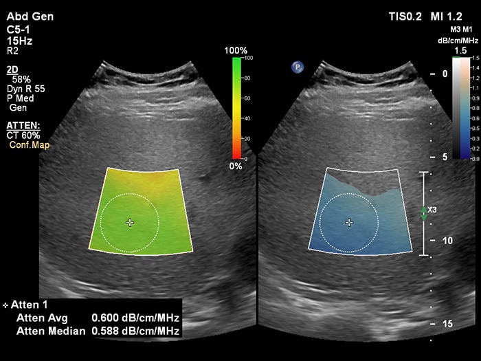 Download image (.jpg) (opens in a new window) EPIQ Ultrasound attenuation imaging 1