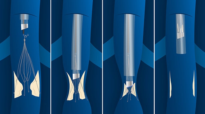 Download image (.jpg) (opens in a new window) Philips IVC Filter Removal Laser Sheath – CavaClear