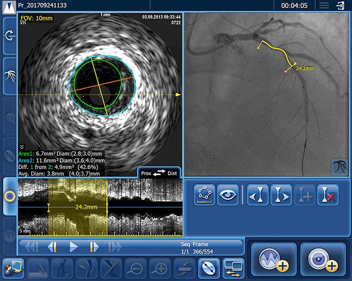 Download image (.jpg) (opens in a new window) Philips intravascular ultrasound (IVUS)