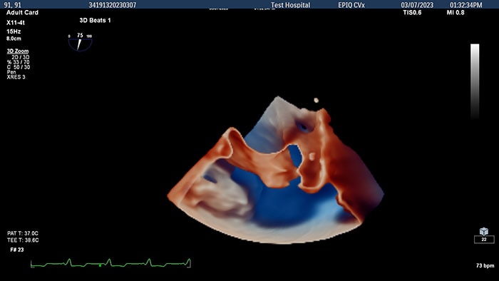 3D view of adult left atrial appendage -  