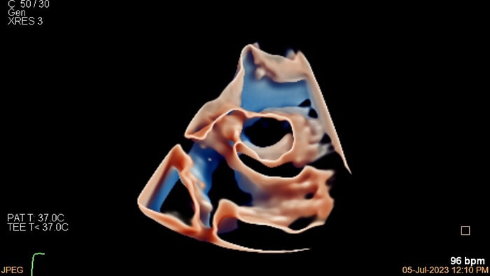 3D View of young pediatric patient heart view  -  