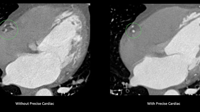 Clinical image of the heart with Precise Cardiac on Philips CT 5300 -  