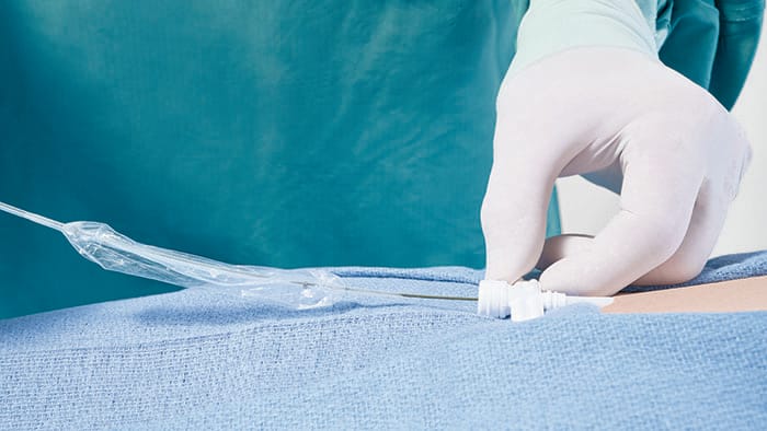 The Philips Bridge Plus Balloon, uninflated prior to use -  