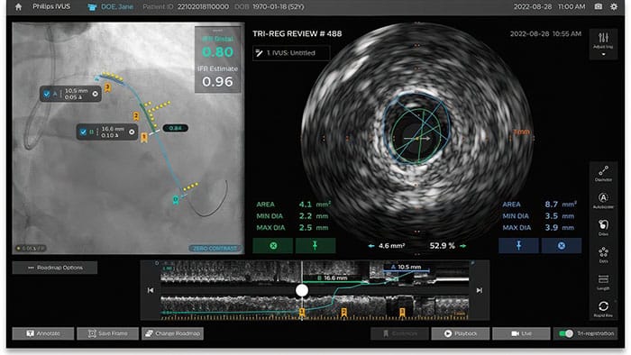 Philips IntraSight Plus screen -  
