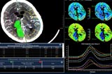 IntelliSpace Portal 9.0 CT Brain Perfusion.