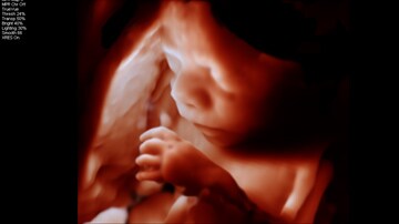 Philips new OB/GYN ultrasound innovations with anatomical intelligence provide lifelike 3D images to advance pregnancy care and support maternal-fetal bonding