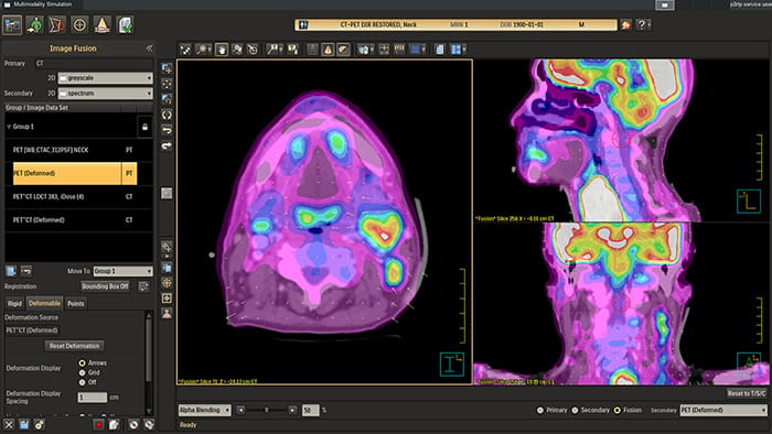 Philips expands radiation therapy simulation portfolio with MM Sim Advance and Mid-Position on Rembra RT